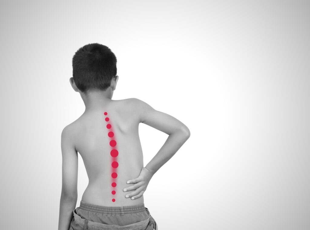 Child with scoliosis, isolated on white background